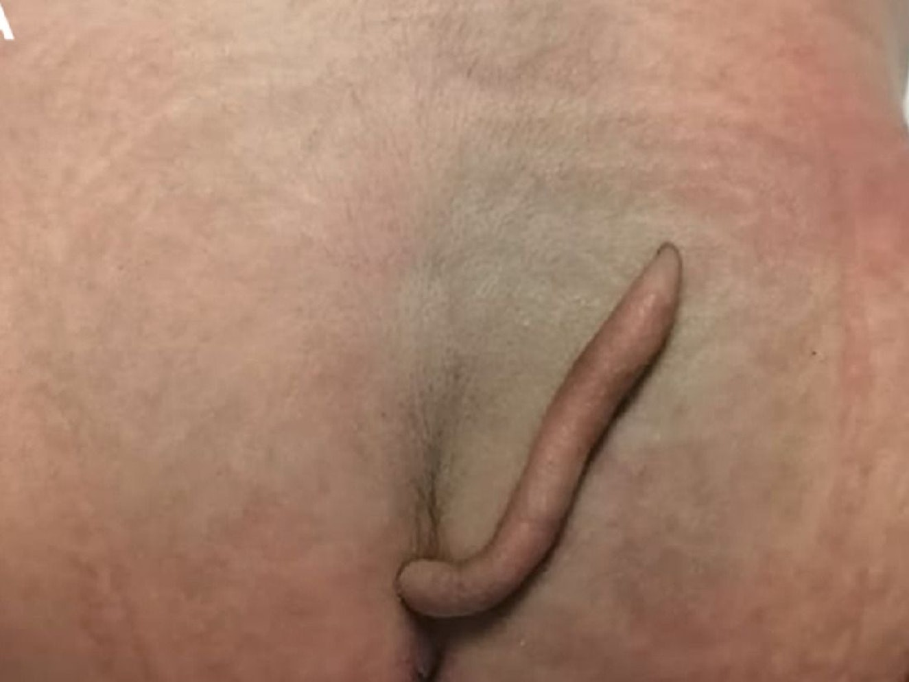 Schwanz am Po eines neugeborenen Mädchens.