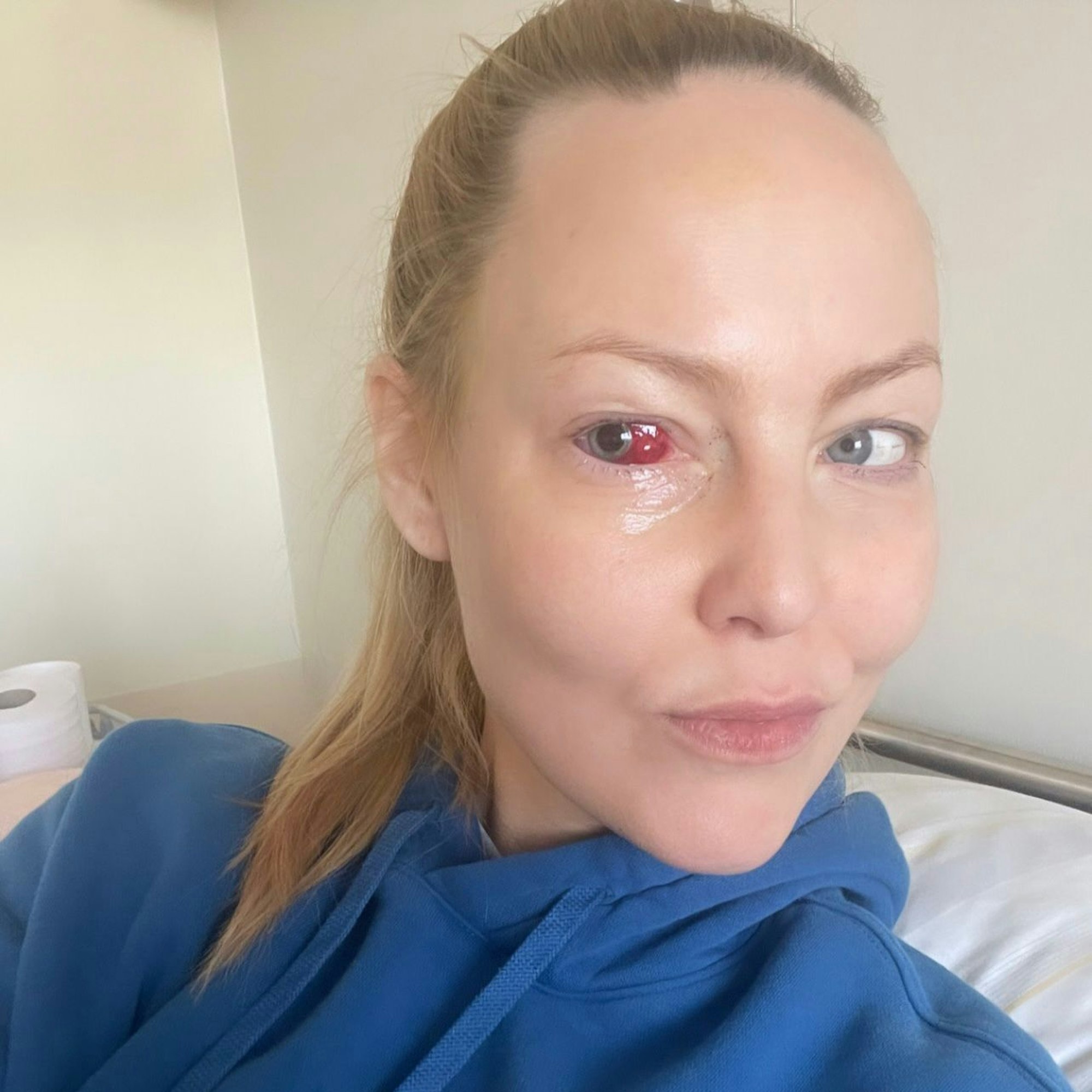 Hanna Hansen mit ein blutgetränkten Auge.