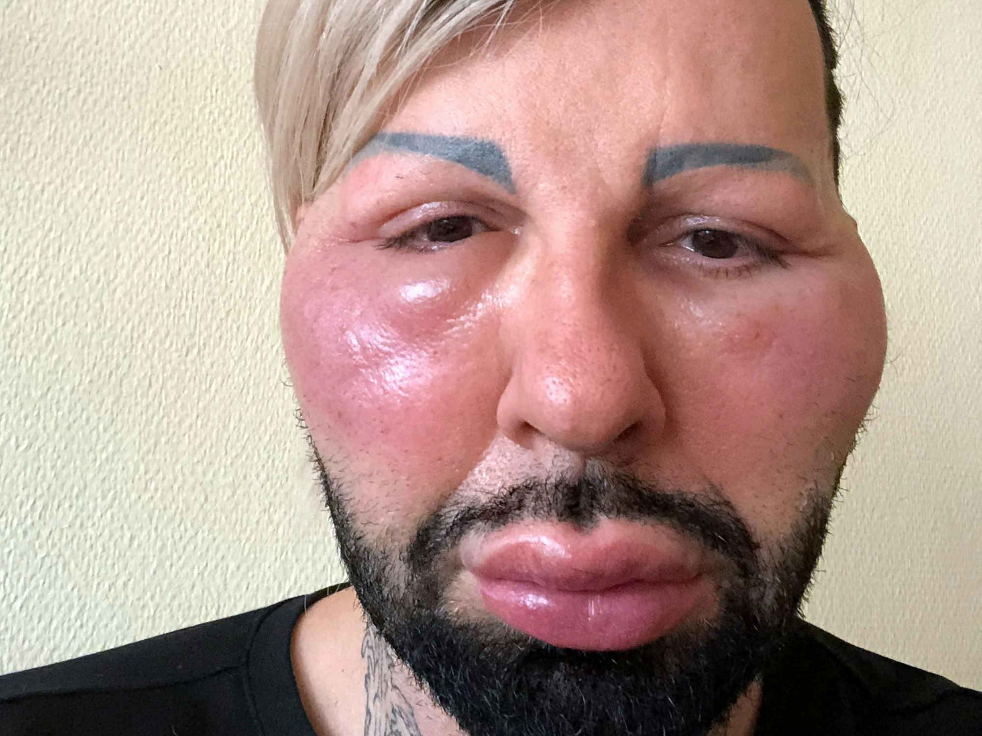 Das Gesicht von Harald Glööckler ist geschwollen. Der Modeschöpfer hatte sich wegen einer Allergie im rheinland-pfälzischen Grünstadt im Juli 2018 in ärztliche Behandlung begeben.