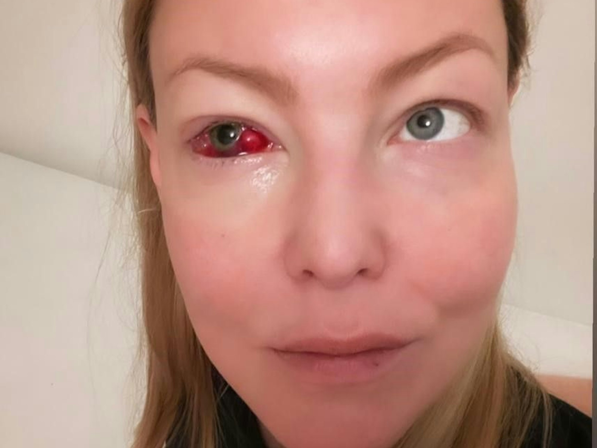 Foto vom blutunterlaufenen Auge von Hanna Hansen.