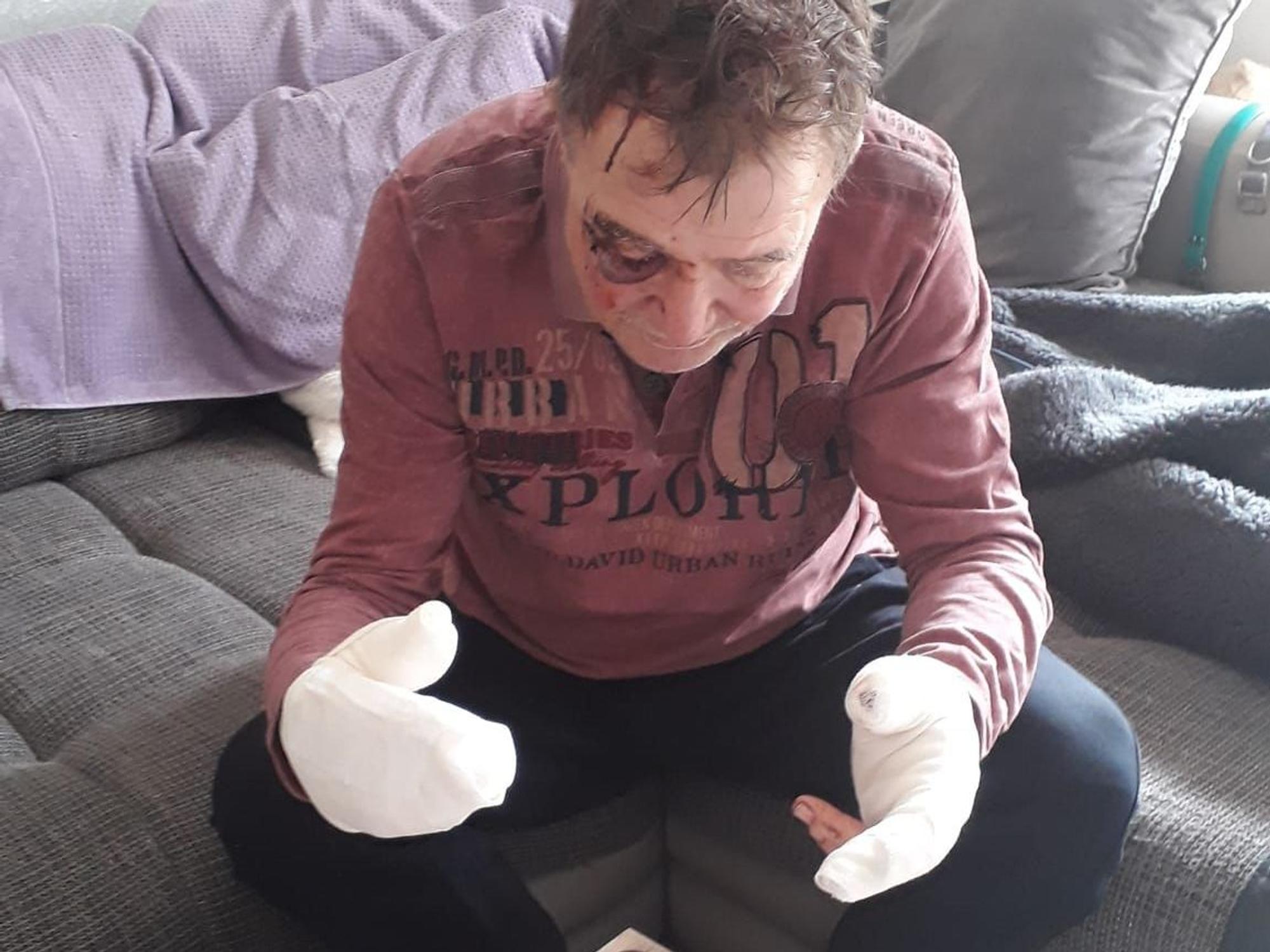 Beide Hände von Josef G. sind dick verbunden, auch hat er ein blaues Auge.