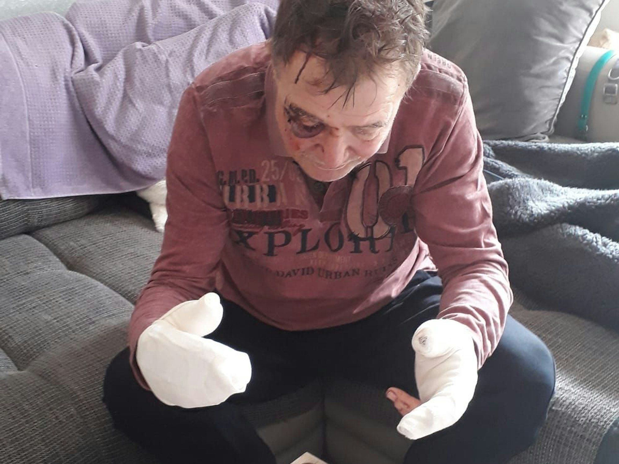 Beide Hände von Josef G. sind dick verbunden, auch hat er ein blaues Auge.