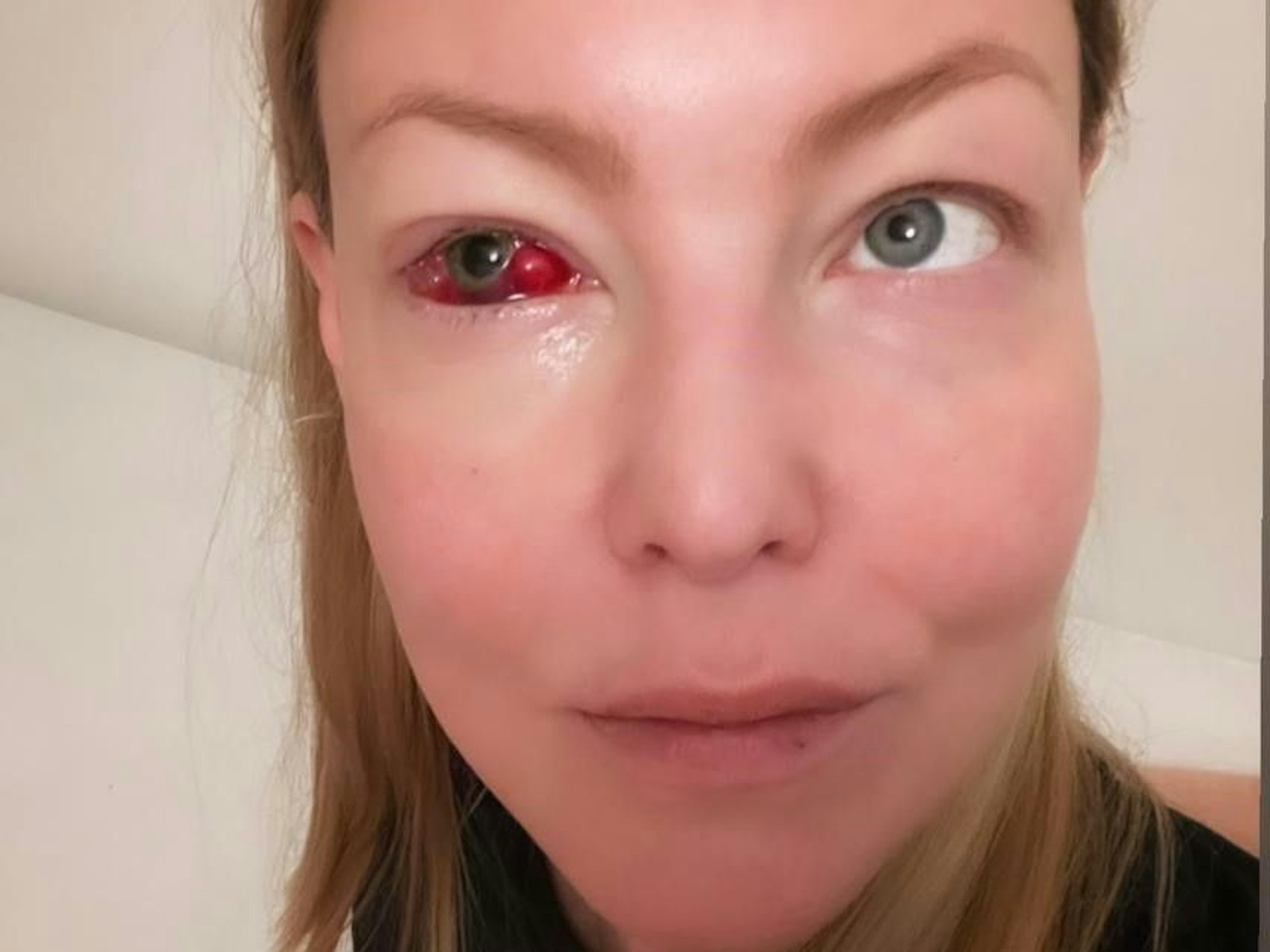 Hanna Hansens blutunterlaufenes Auge.