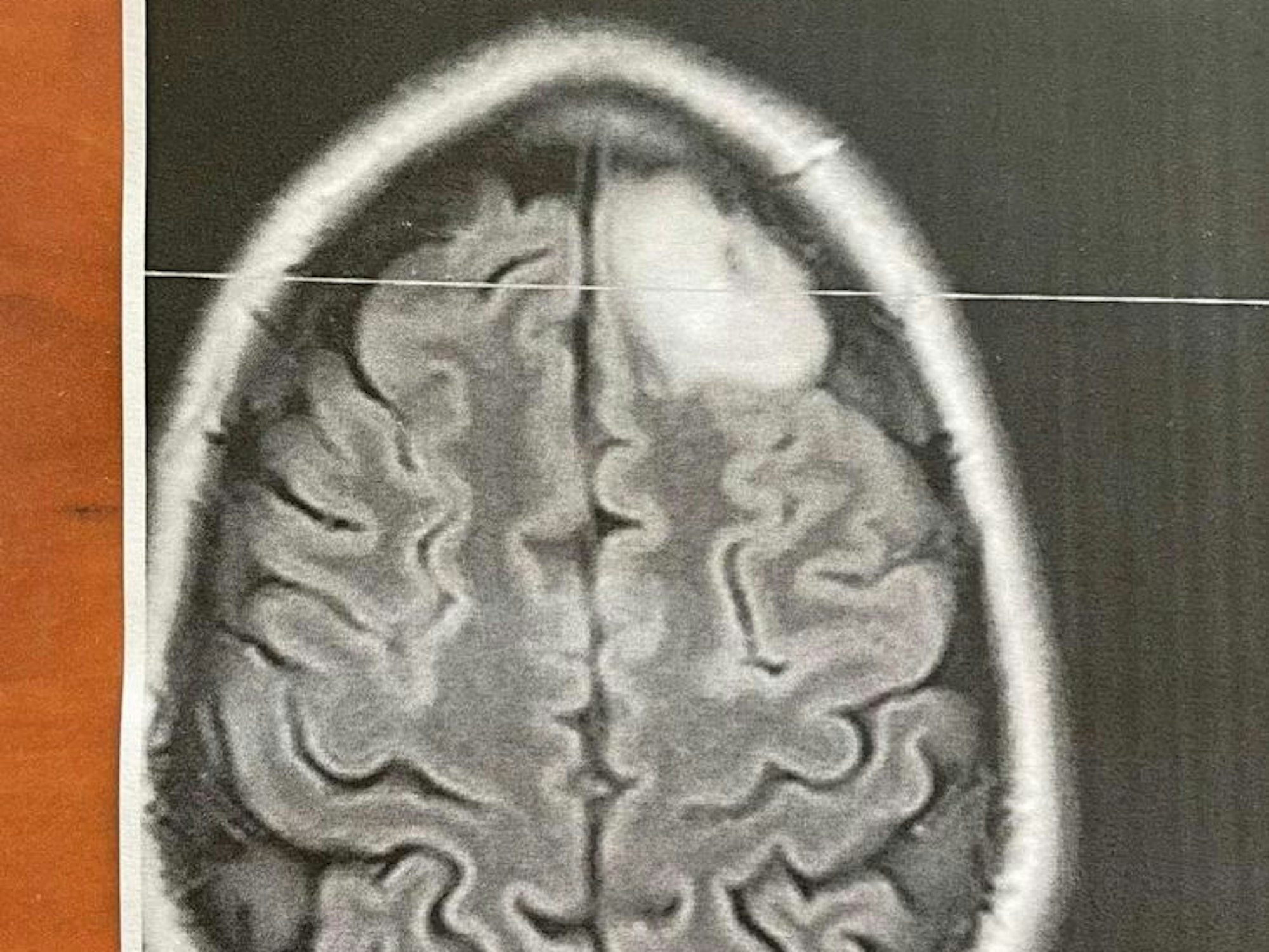 Röntgen-Aufnahme eines Gehirns von oben gesehen. Eine weiße Fläche zeigt den Tumor.
