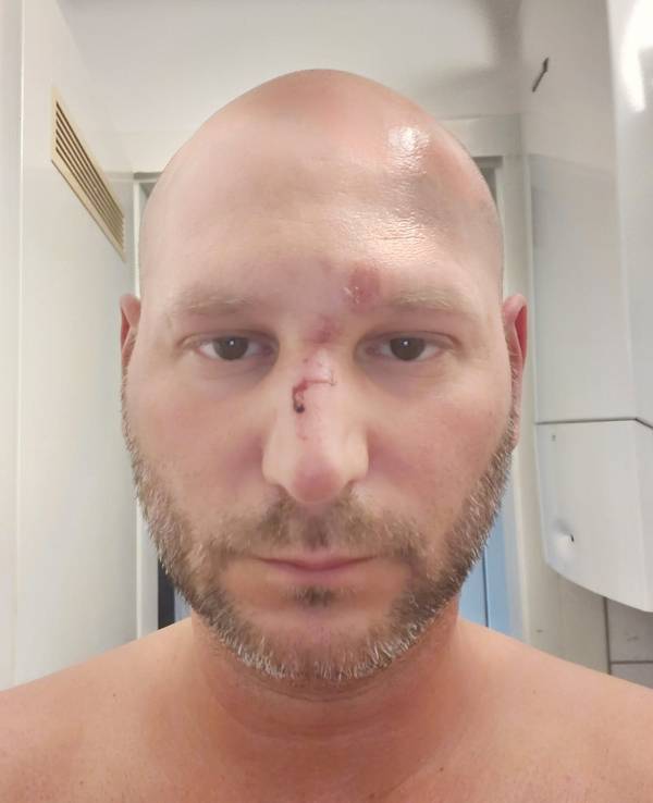 Im Gesicht von Ben Ü. sieht man Abschürfungen und Prellungen, auf der Nase ist etwas Blut.