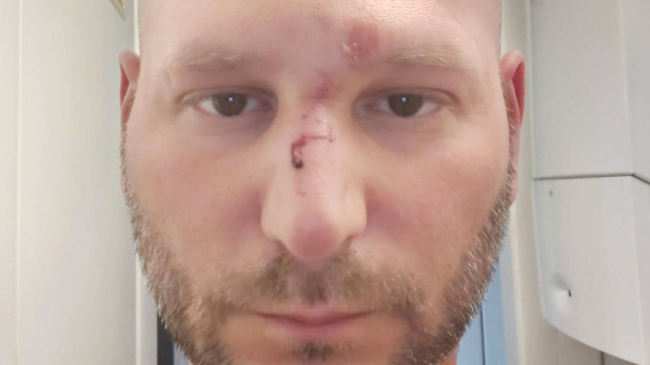 Im Gesicht von Ben Ü. sieht man Abschürfungen und Prellungen, auf der Nase ist etwas Blut.