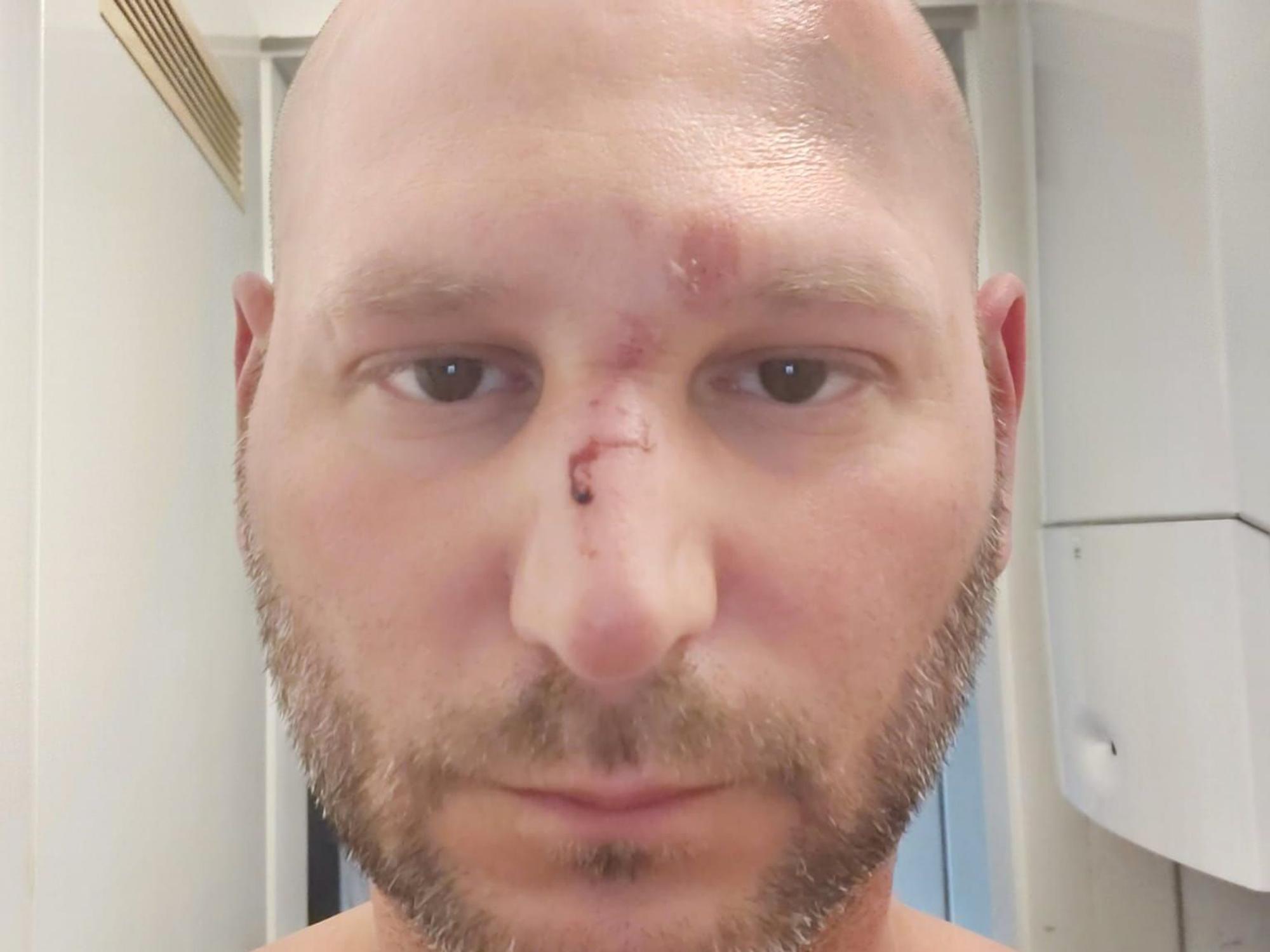 Im Gesicht von Ben Ü. sieht man Abschürfungen und Prellungen, auf der Nase ist etwas Blut.