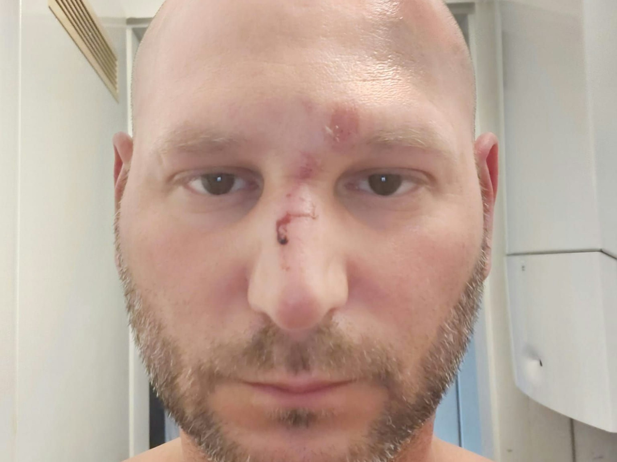 Im Gesicht von Ben Ü. sieht man Abschürfungen und Prellungen, auf der Nase ist etwas Blut.