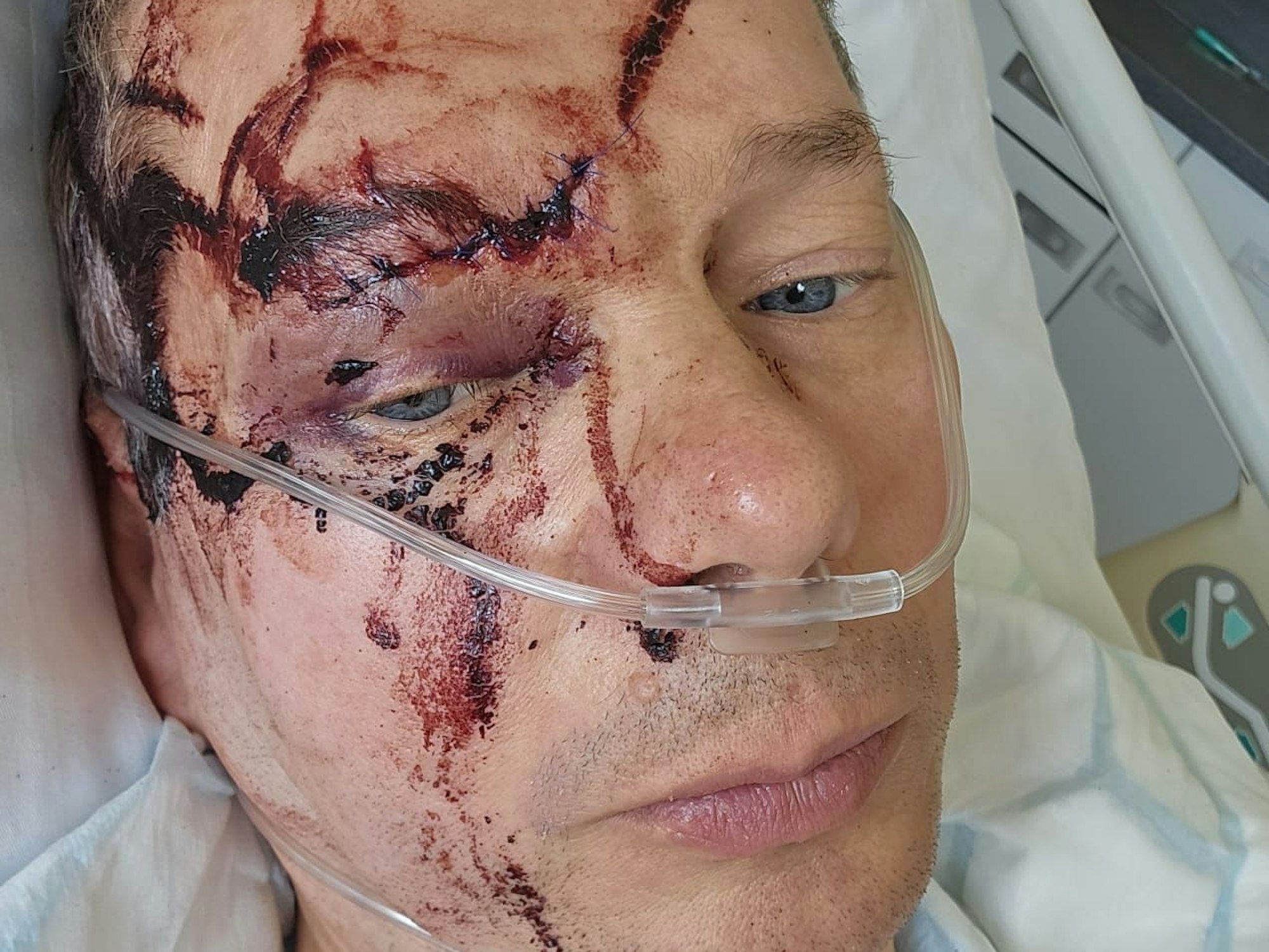 Verletzter Mann mit Blutflecken im Gesicht schaut für ein Selfie im Krankenhaus in die Kamera.