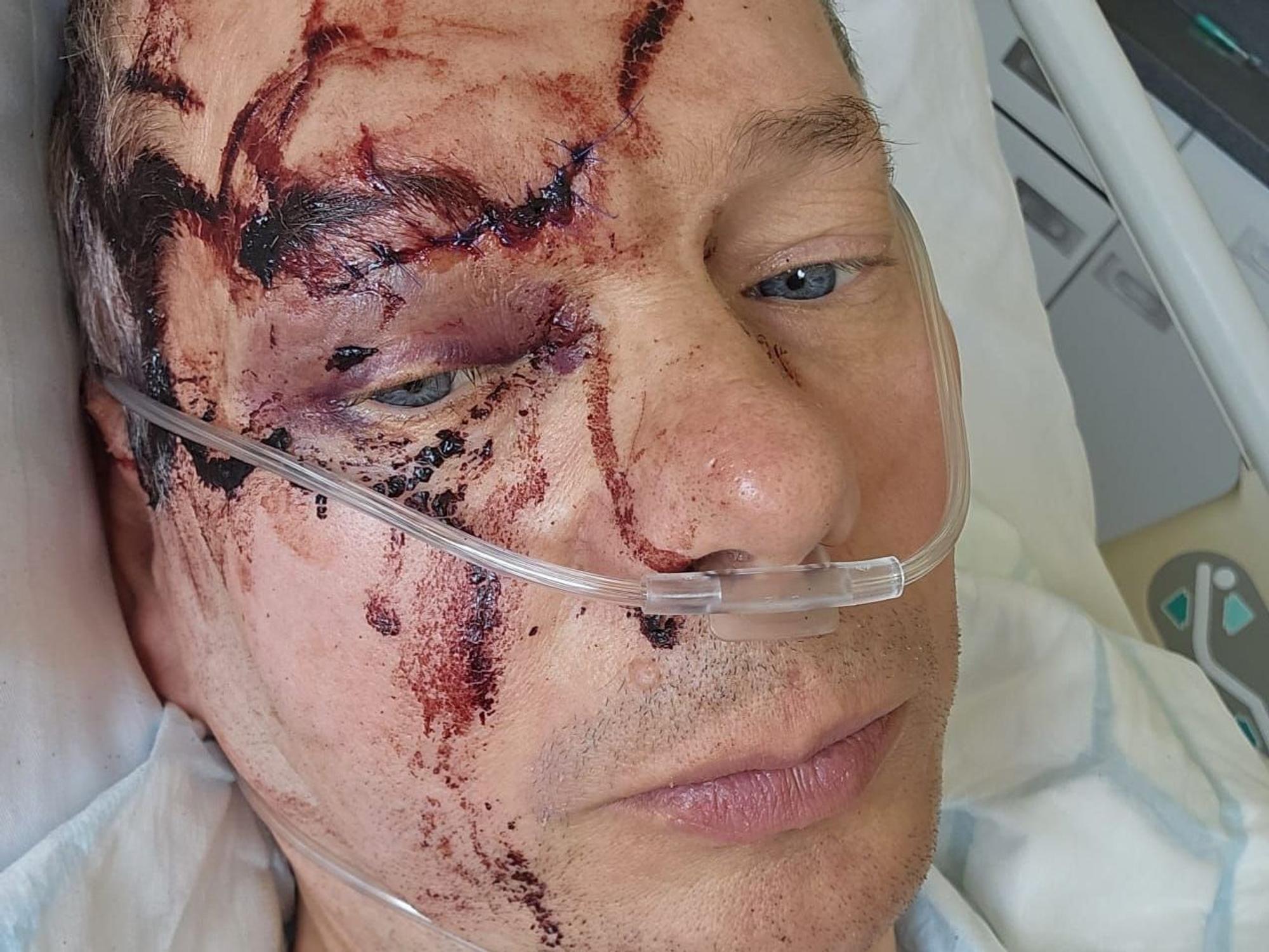 Verletzter Mann mit Blutflecken im Gesicht schaut für ein Selfie im Krankenhaus in die Kamera.