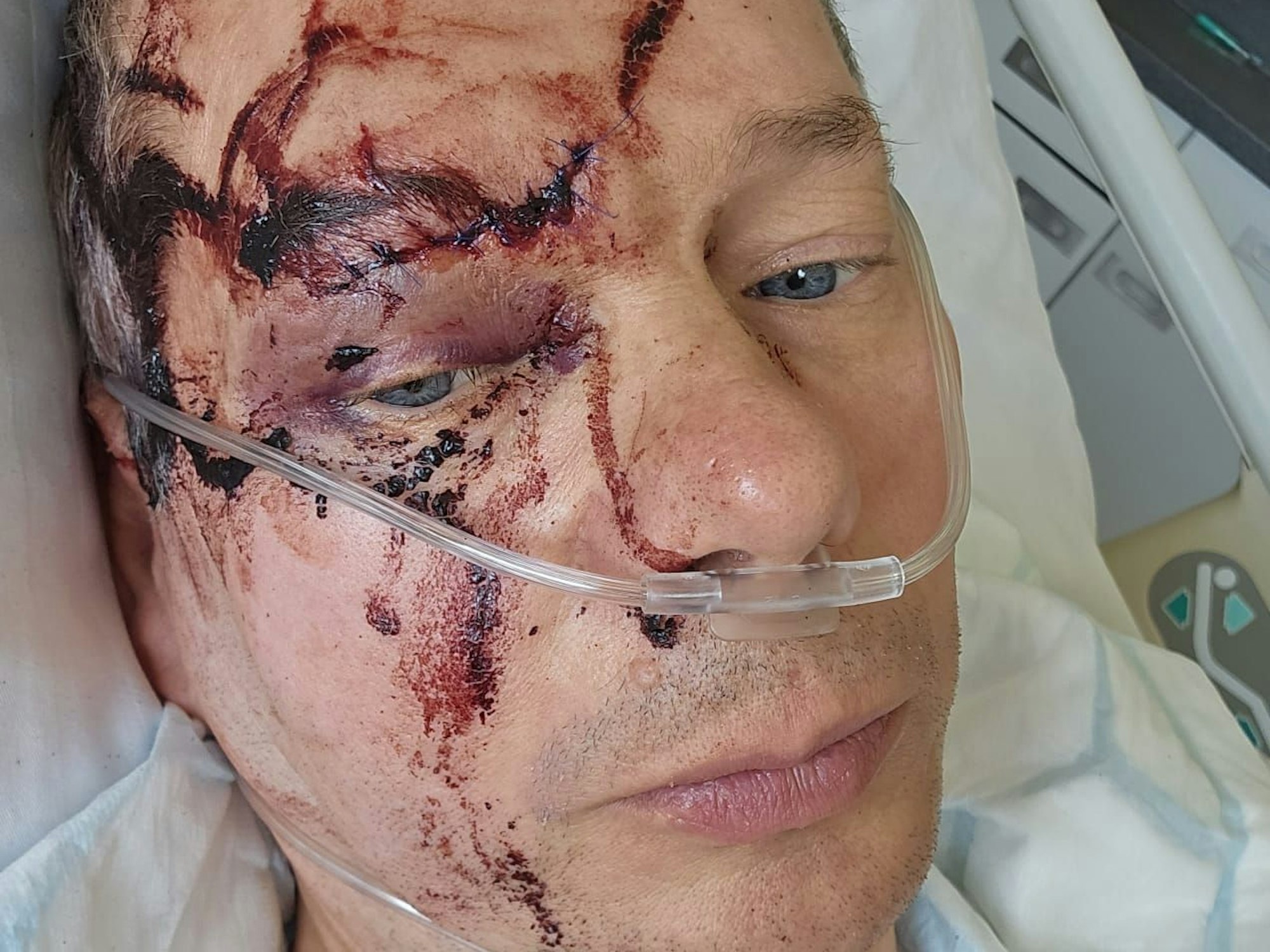 Verletzter Mann mit Blutflecken im Gesicht schaut für ein Selfie im Krankenhaus in die Kamera.