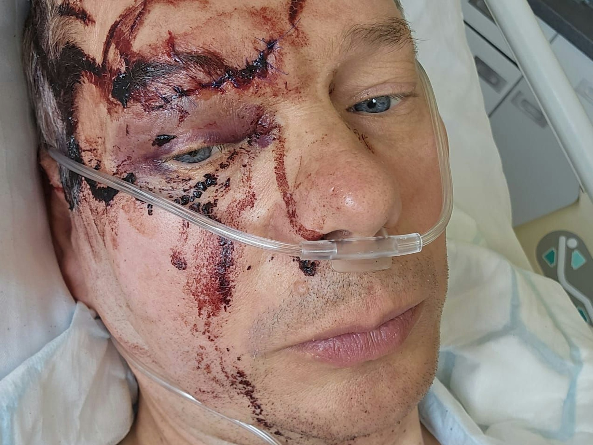 Verletzter Mann mit Blutflecken im Gesicht schaut für ein Selfie im Krankenhaus in die Kamera.
