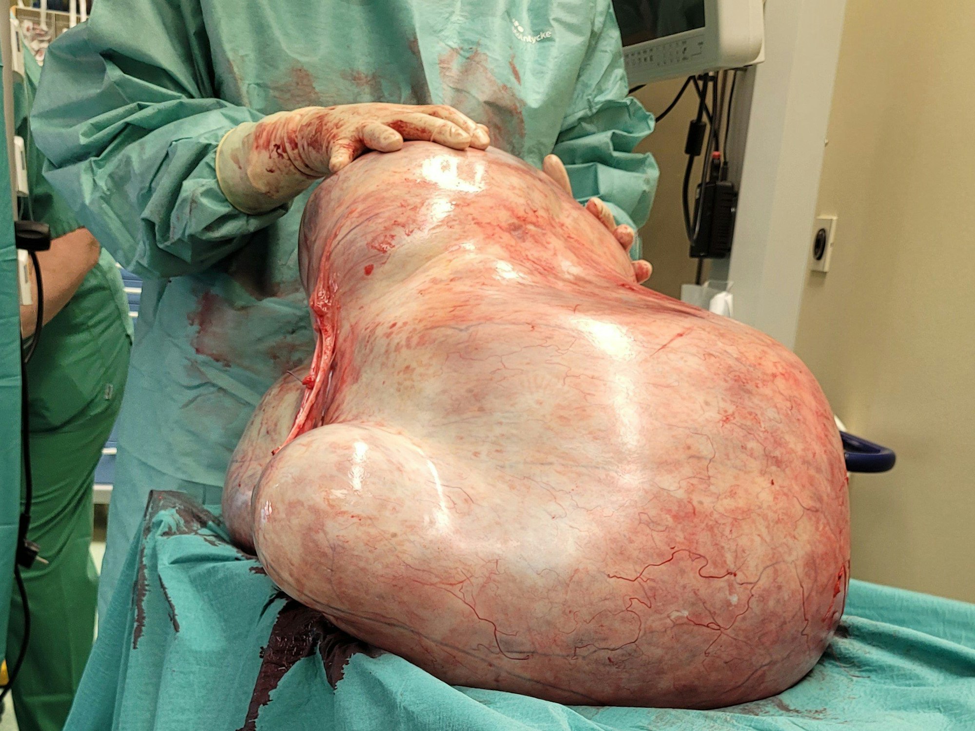 Ein 32 Kilogramm schwerer Tumor, der einer jungen Frau entfernt wurde, liegt in einem Raum der Universitätsklinik.
