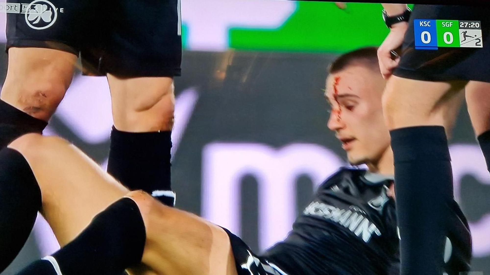 Tim Lemperle blutet nach einem Zweikampf beim Spiel von Greuther Fürth in Karlsruhe im Gesicht.
