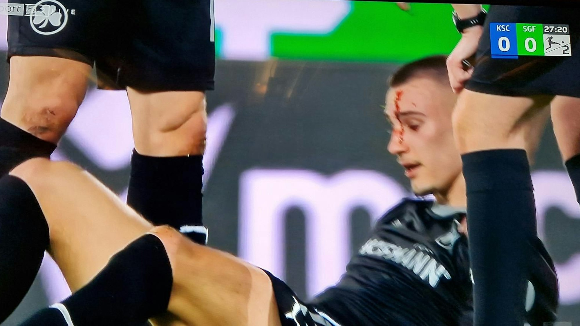 Tim Lemperle blutet nach einem Zweikampf beim Spiel von Greuther Fürth in Karlsruhe im Gesicht.