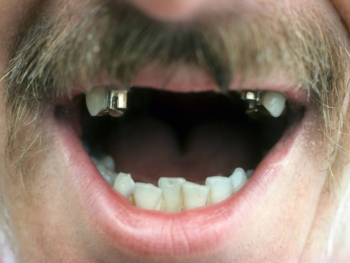 Der Kölner Eishockey-Spieler Wim Hospelt zeigt sein lückenhaftes Eishockey-Gebiss.