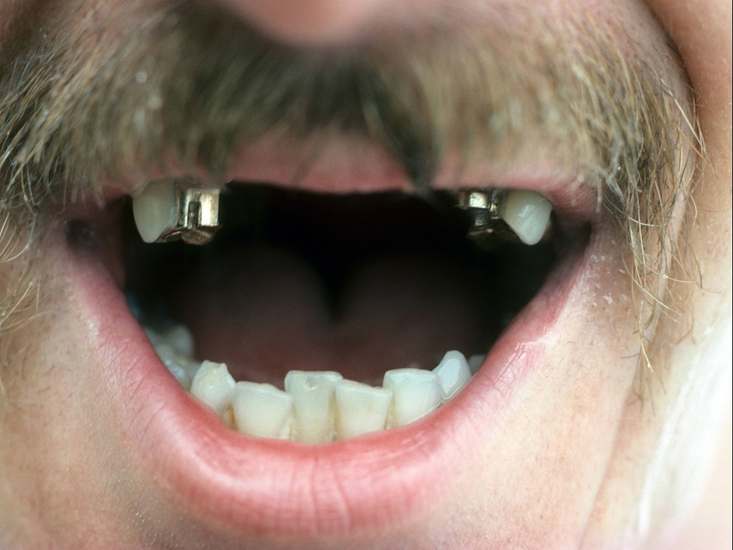 Der Kölner Eishockey-Spieler Wim Hospelt zeigt sein lückenhaftes Eishockey-Gebiss.