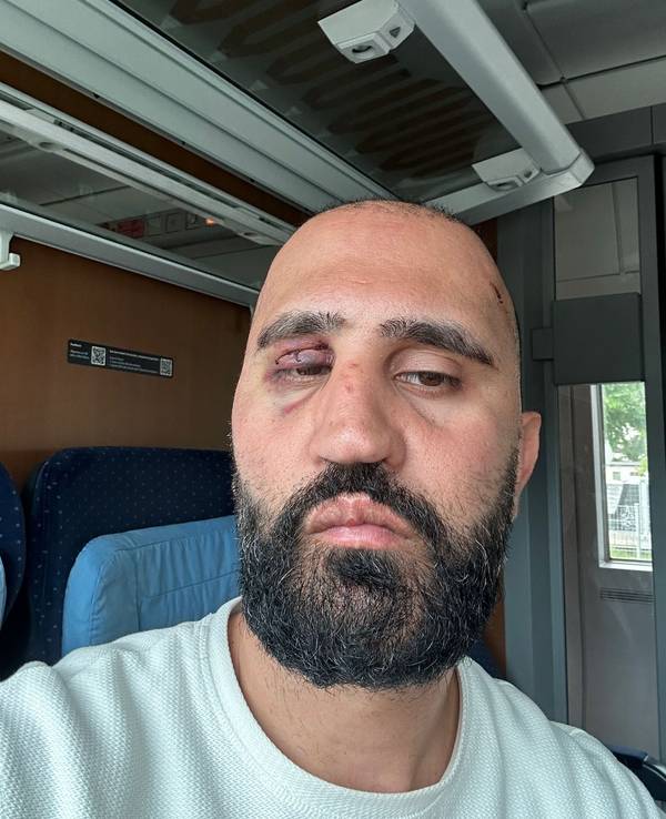 En Mann mit blauem Auge schaut in die Kamera.