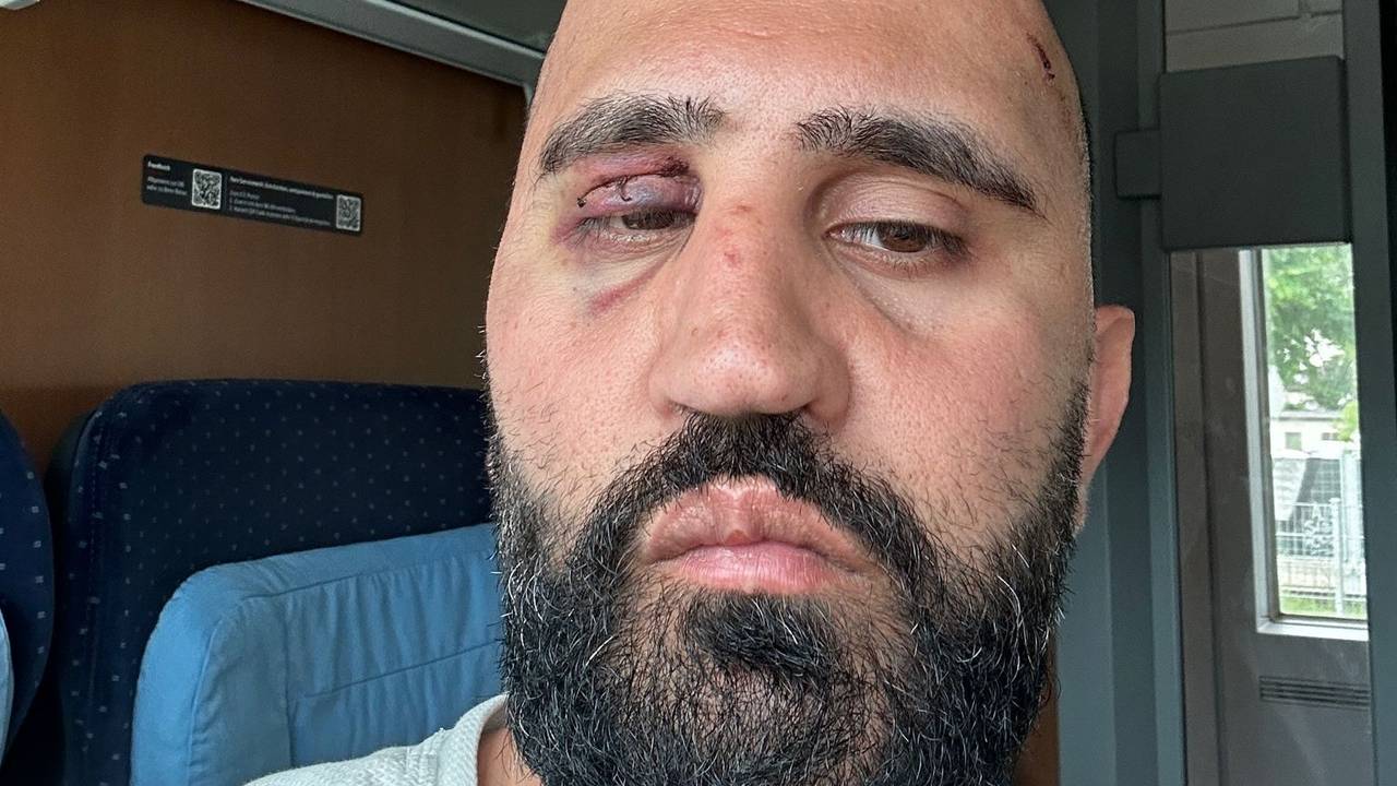 En Mann mit blauem Auge schaut in die Kamera.