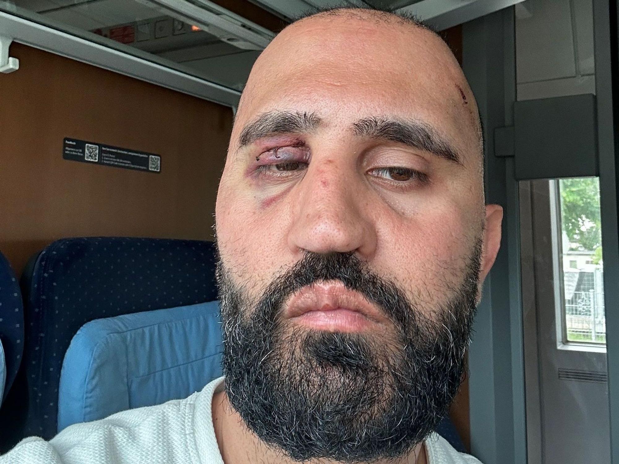 En Mann mit blauem Auge schaut in die Kamera.