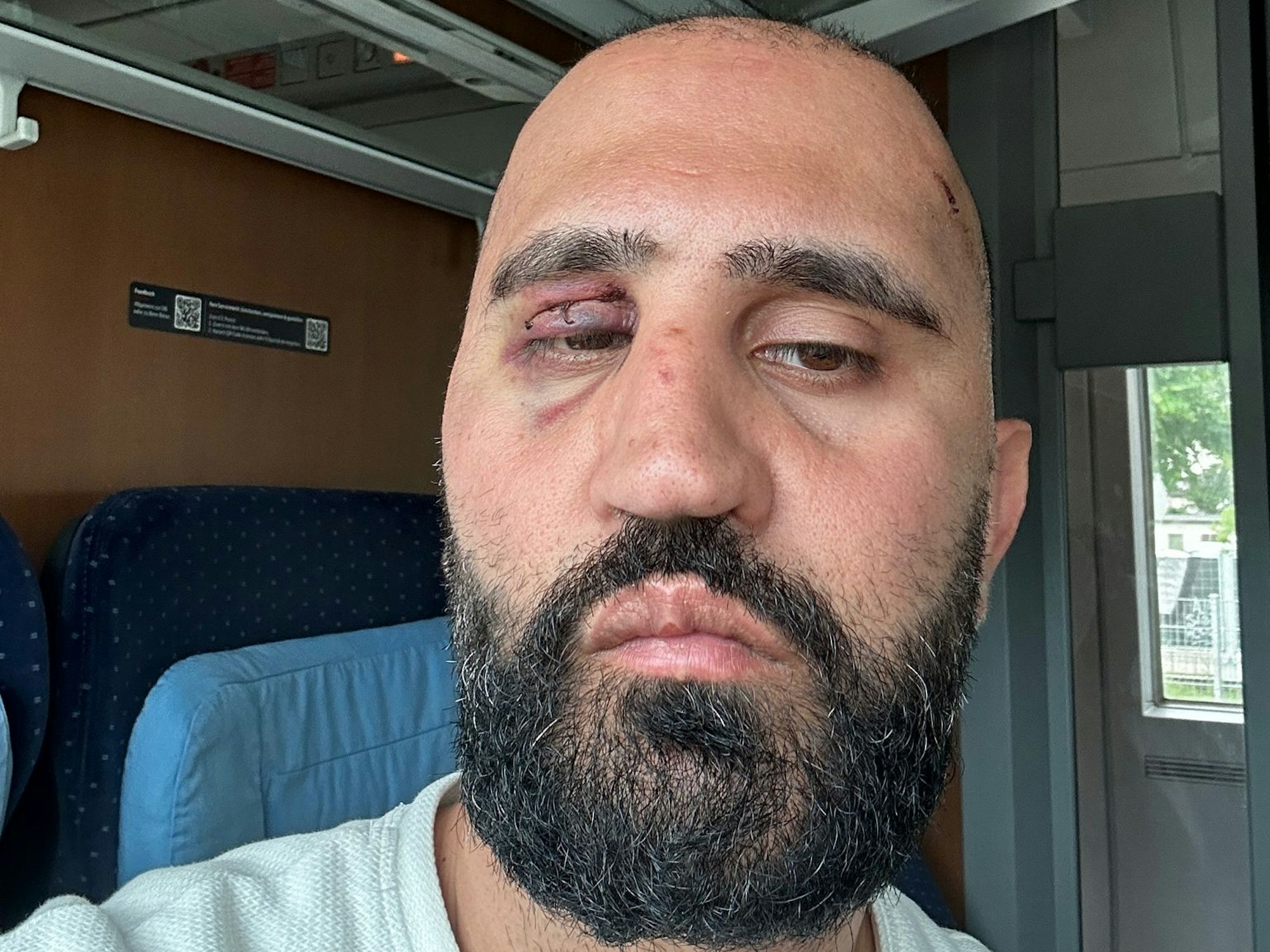 En Mann mit blauem Auge schaut in die Kamera.