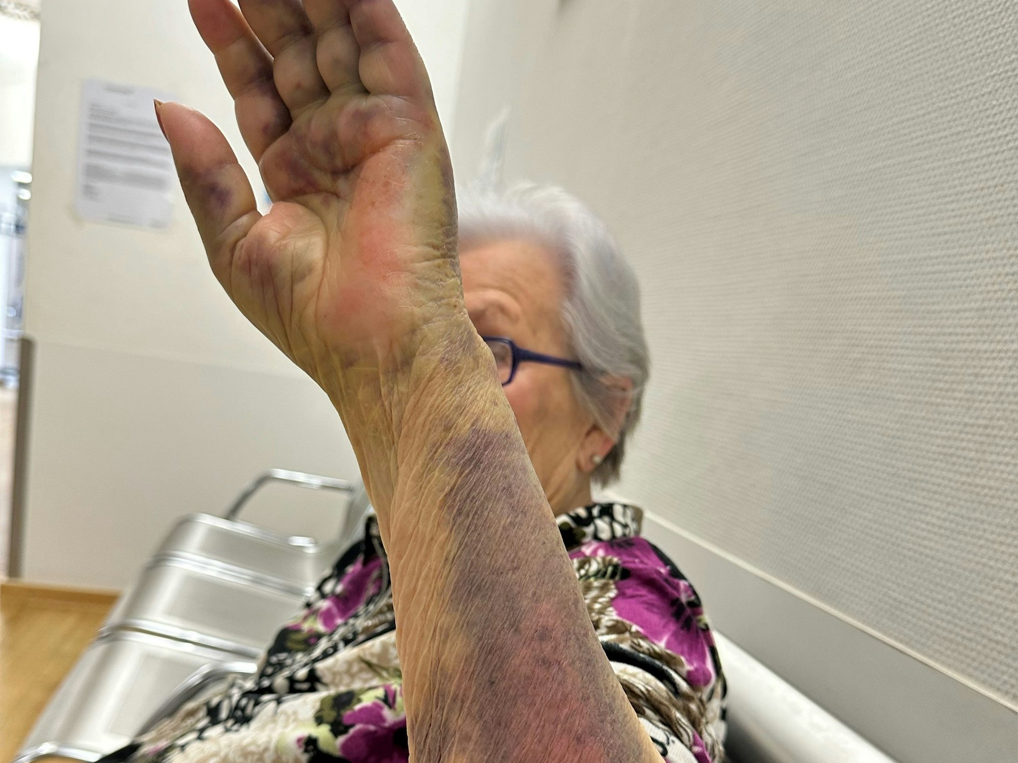 Maria Fischer (85) zeigt ihren Arm und ihre dicke Hand.