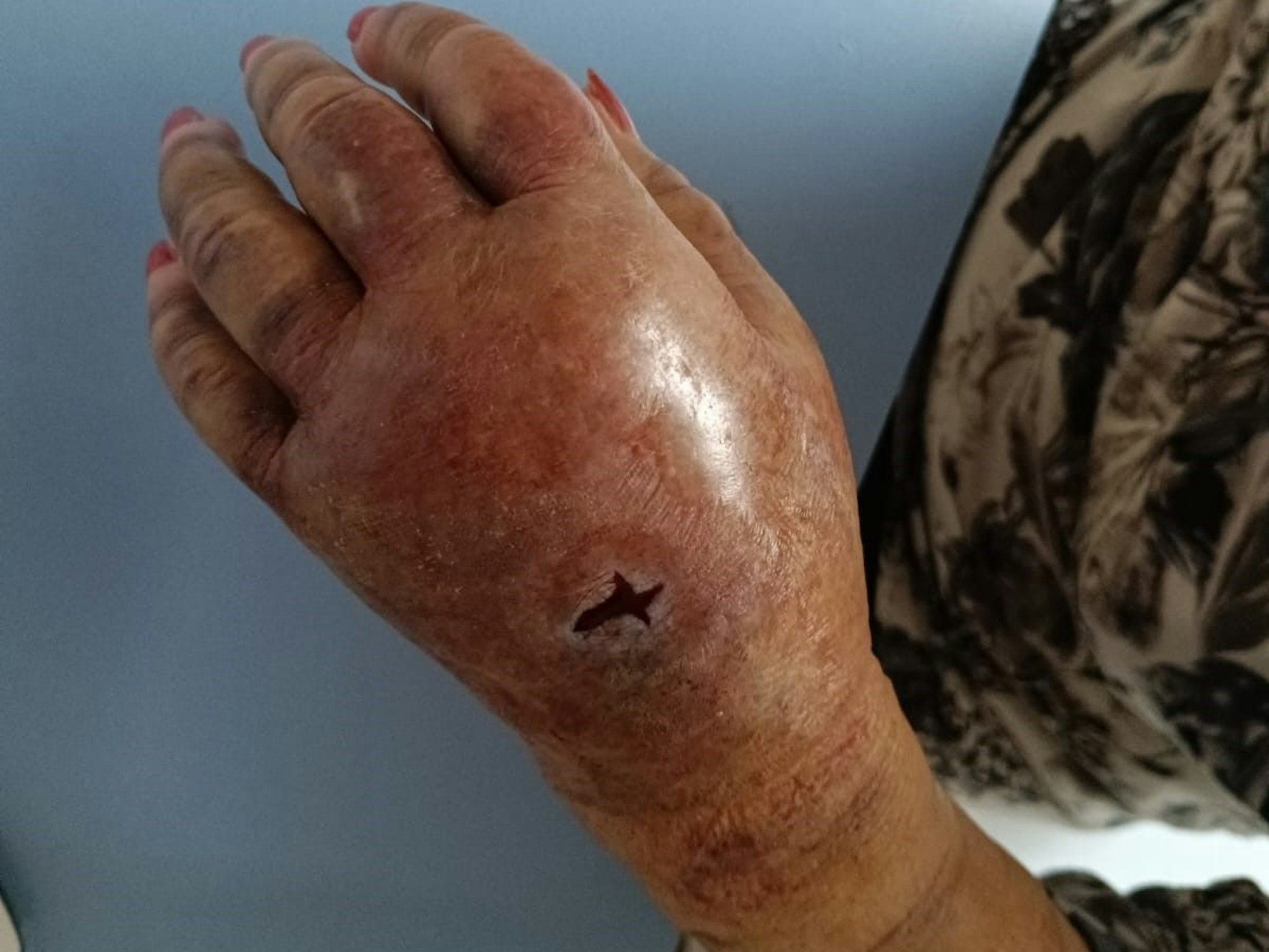 Eine extrem geschwollene Hand