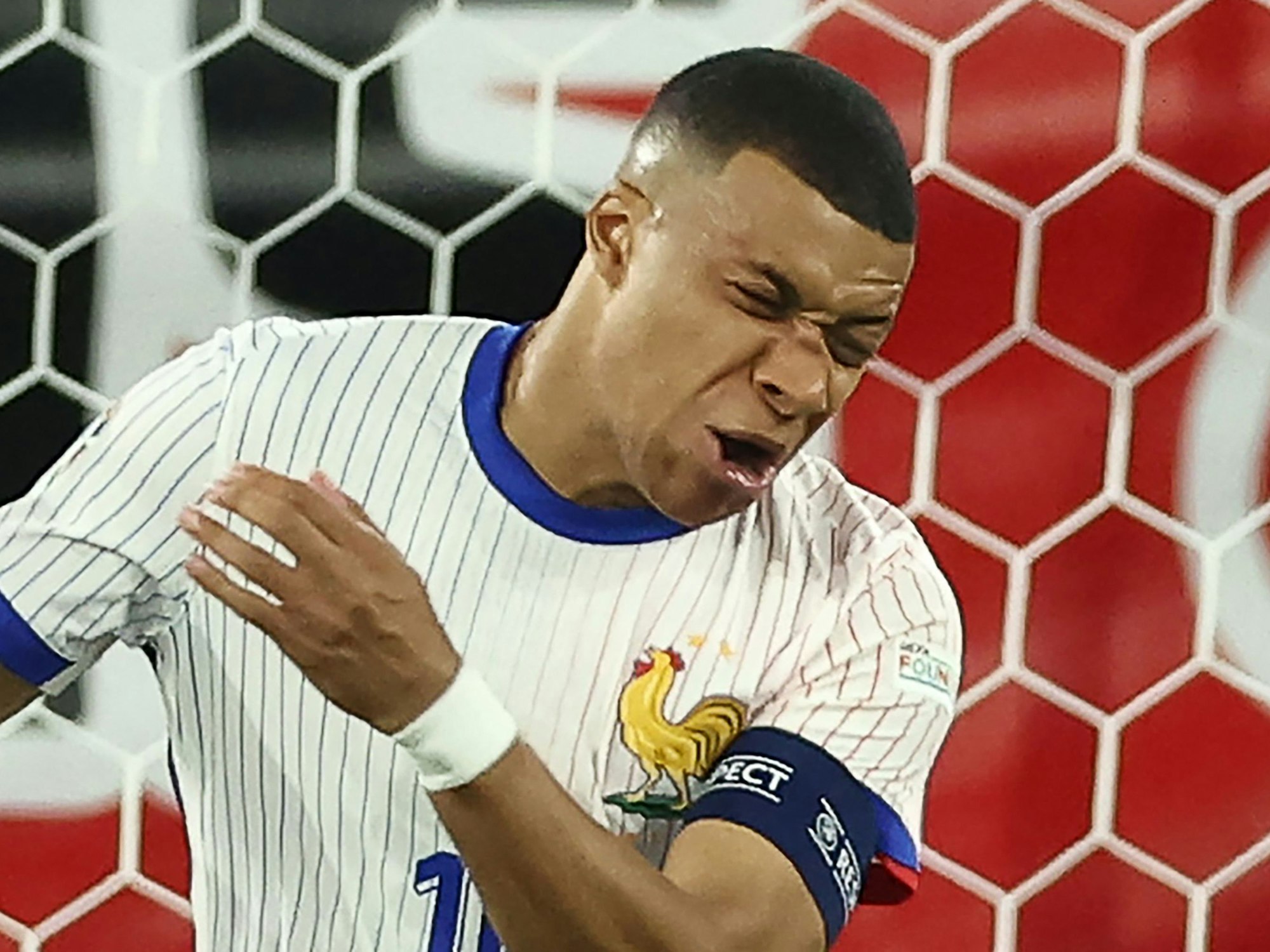 Kylian Mbappé mit gebrochenem Nasenbein.