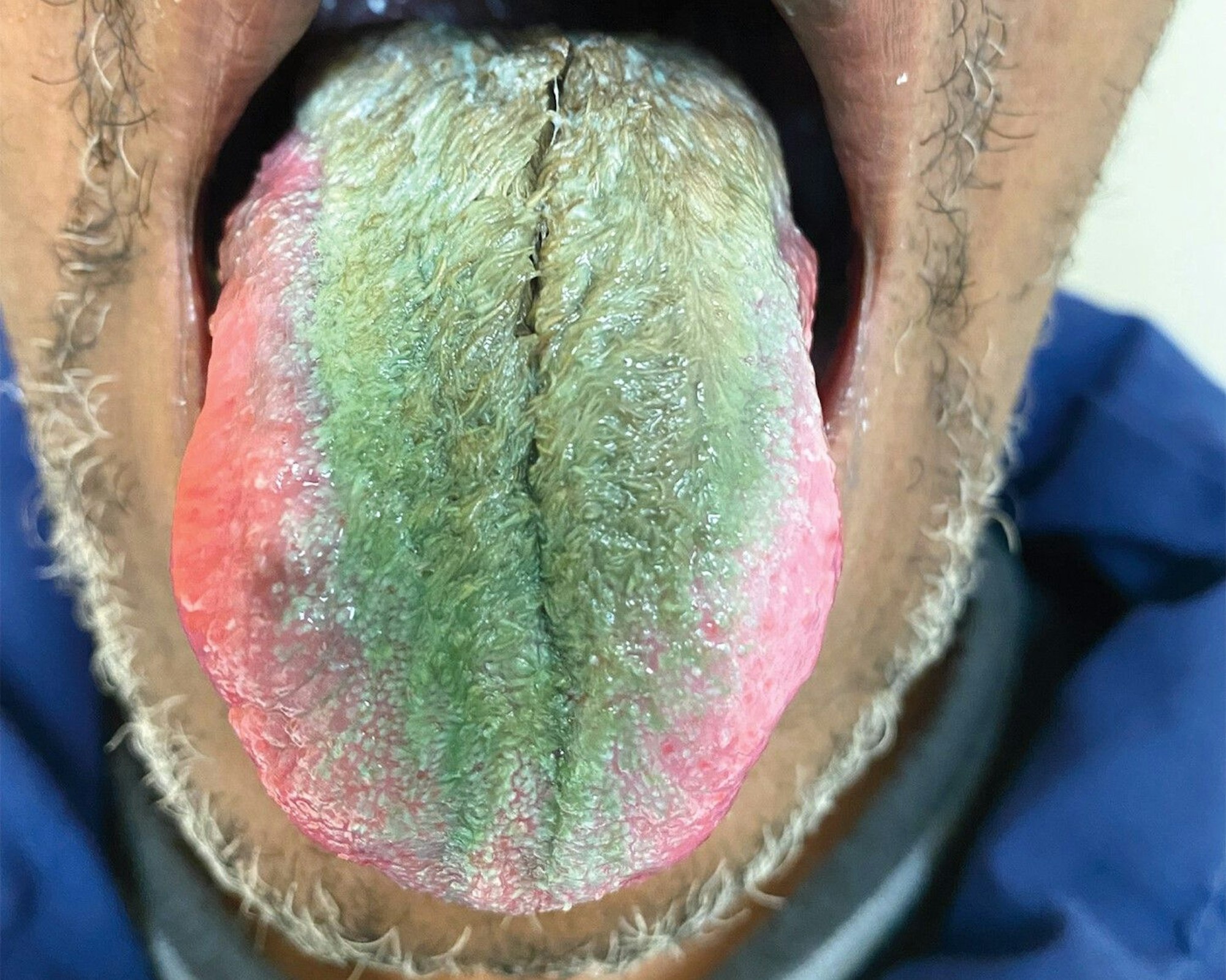 Rauchen und Antibiotika: Diese Kombination hat einem Mann eine grüne, haarige Zunge beschert.
