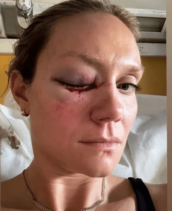 Micha Hancock zeigt sich mit ihrem blauen Auge nach dem Unfall im Krankenhaus
