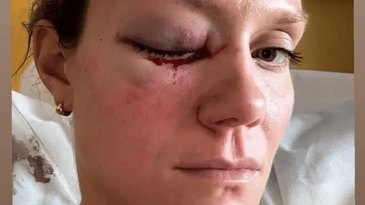 Micha Hancock zeigt sich mit ihrem blauen Auge nach dem Unfall im Krankenhaus