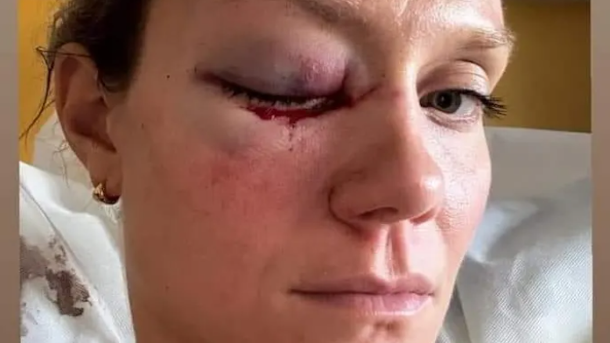 Micha Hancock zeigt sich mit ihrem blauen Auge nach dem Unfall im Krankenhaus