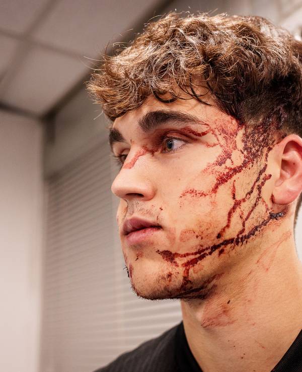 Dieses Bild des blutüberströmten Pau Cubarsi postete der FC Barcelona am Mittwochabend (6. November 2024) auf X.