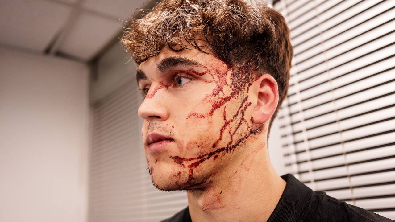 Dieses Bild des blutüberströmten Pau Cubarsi postete der FC Barcelona am Mittwochabend (6. November 2024) auf X.