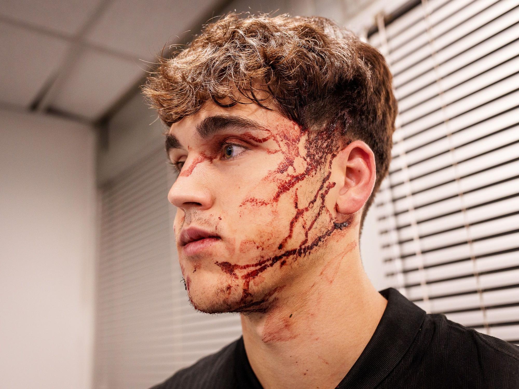 Dieses Bild des blutüberströmten Pau Cubarsi postete der FC Barcelona am Mittwochabend (6. November 2024) auf X.