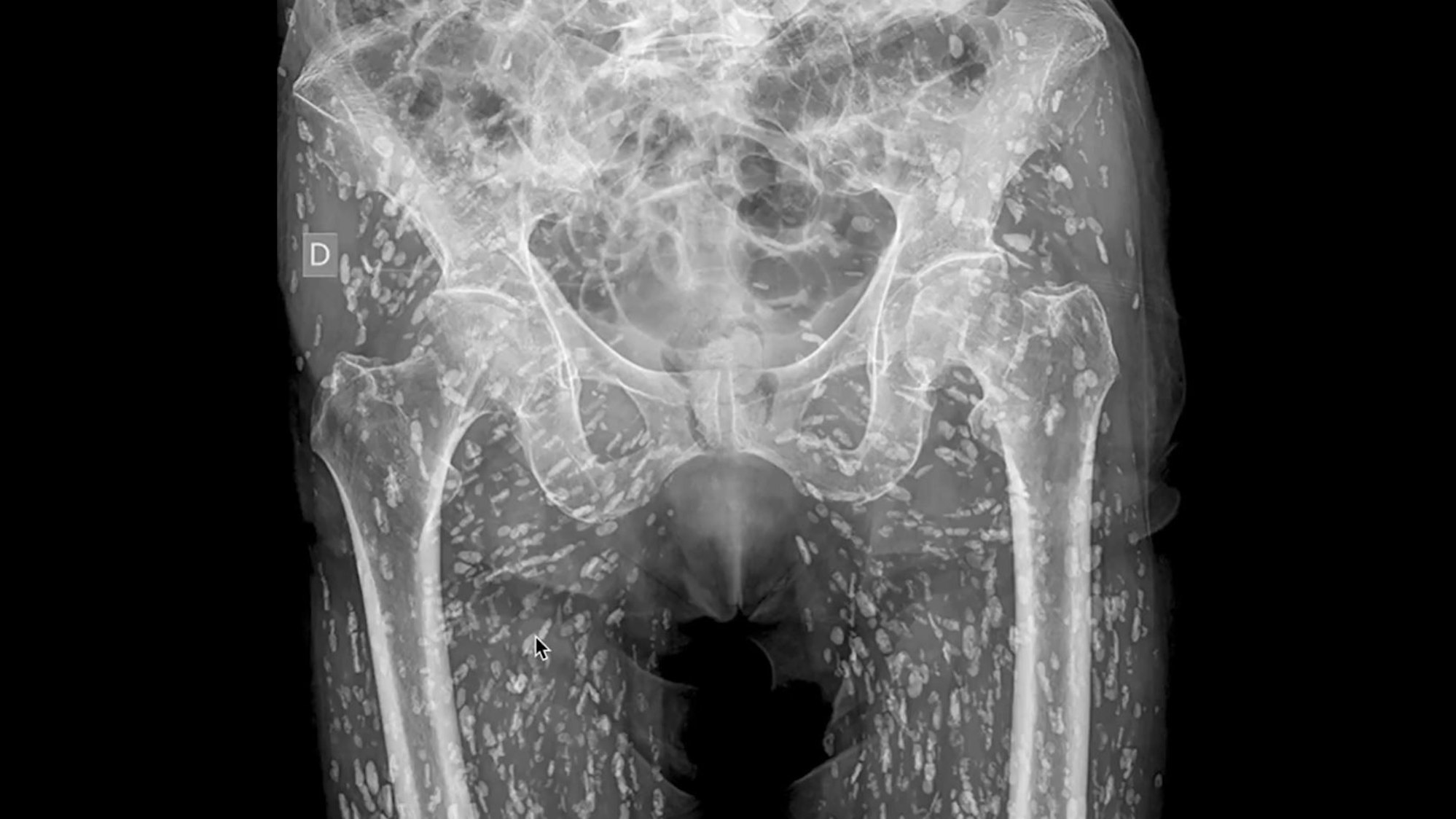 Zu sehen sind auf diesem im Januar 2025 von Sam Ghali auf X veröffentlichten Röntgenbild der Beckenbereich und die Oberschenkel einer Person, die von Parasiten befallen sind.