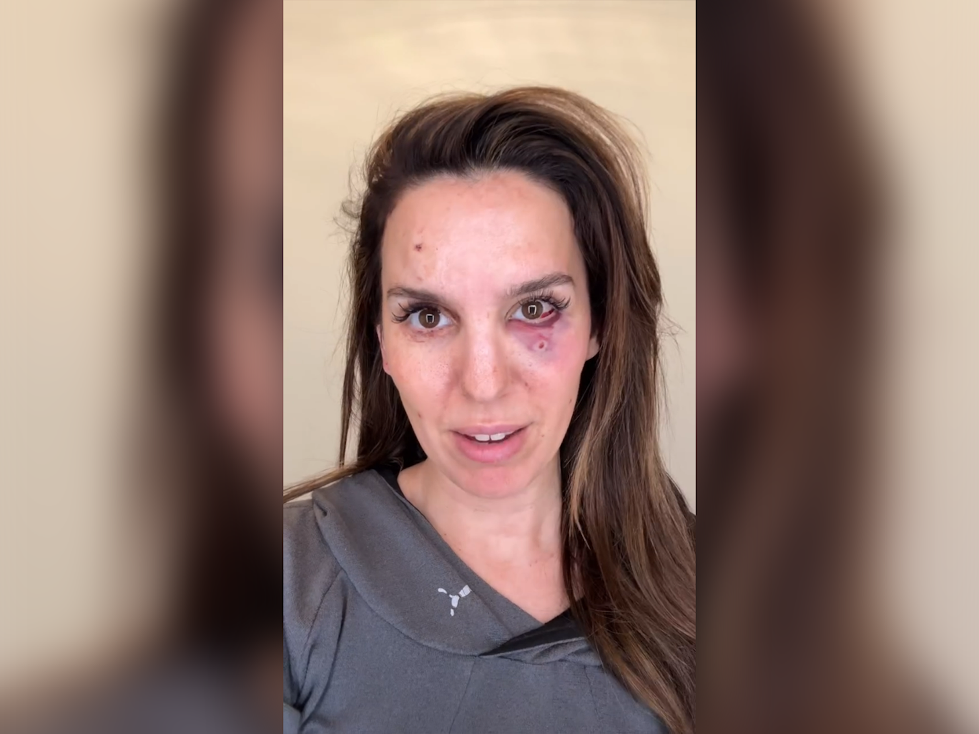 Christy Carlson Romano wurde bei einem Tontaubenschießausflug mit ihrem Mann zu dessen Geburtstag „ins Auge geschossen“.