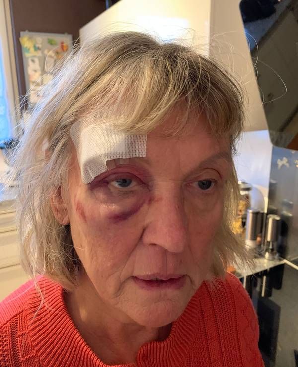 Eine Frau mit blauem Auge schaut in die Kamera.