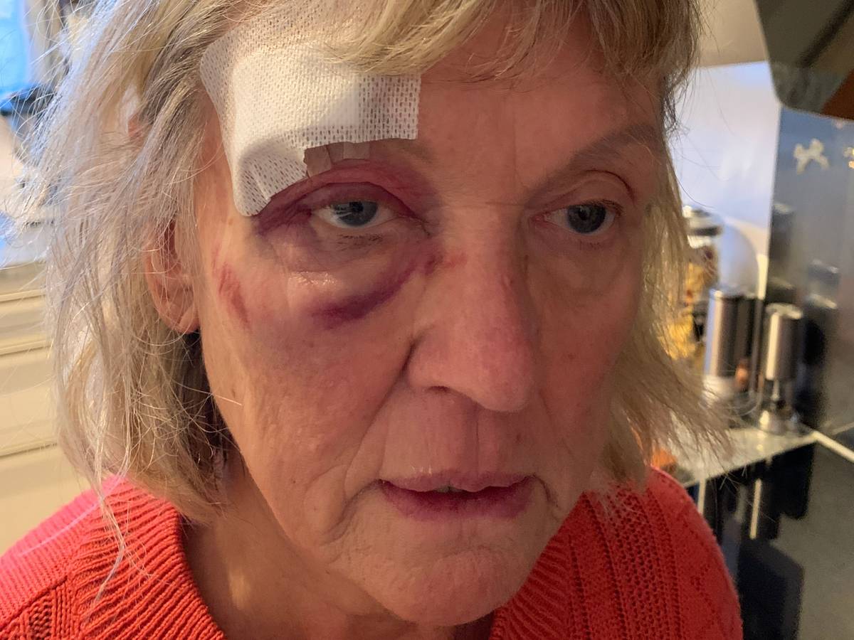 Eine Frau mit blauem Auge schaut in die Kamera.