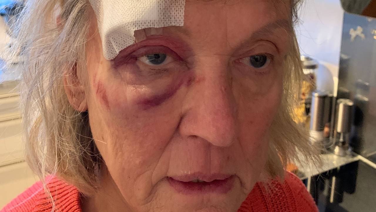 Eine Frau mit blauem Auge schaut in die Kamera.