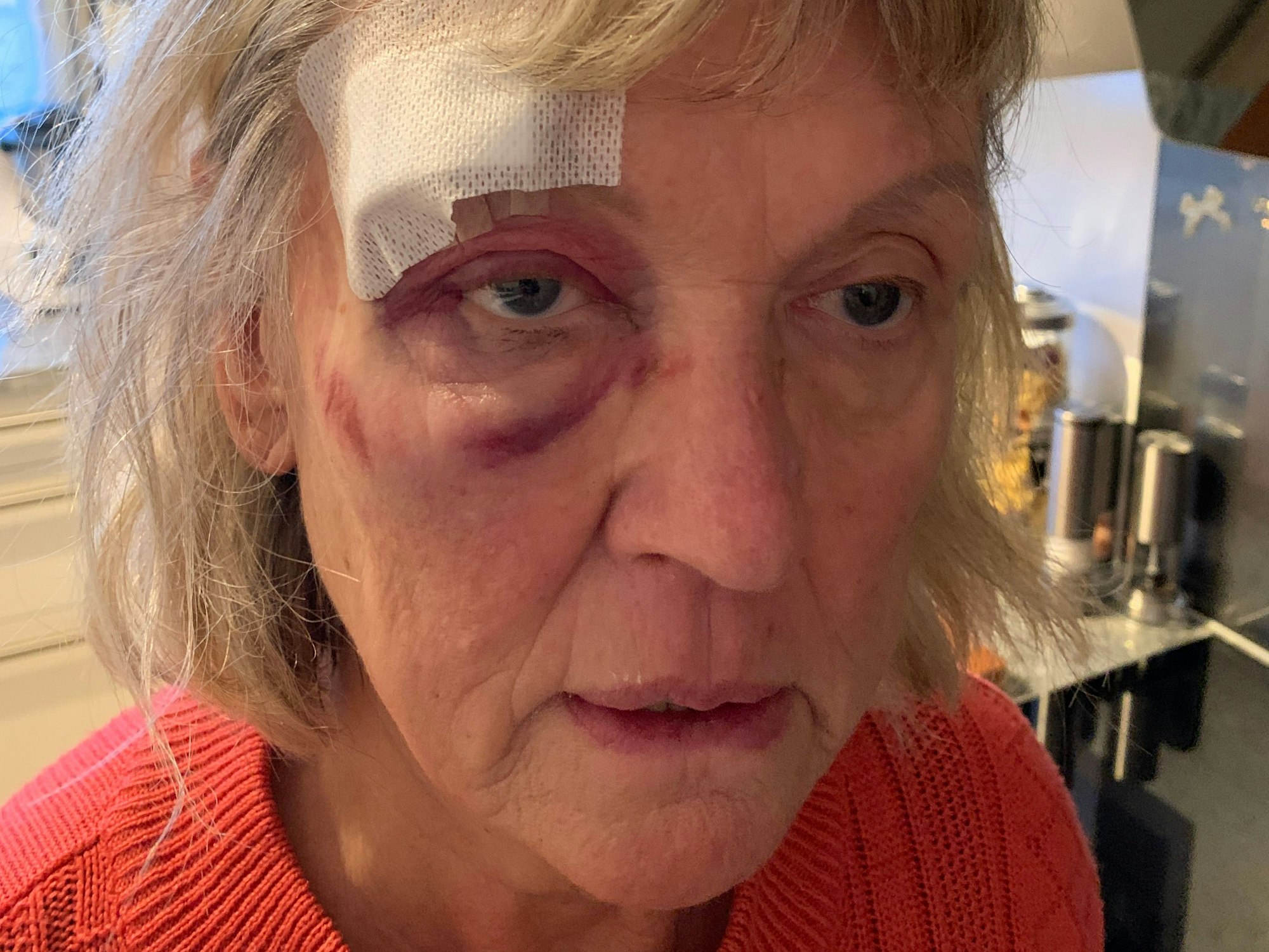 Eine Frau mit blauem Auge schaut in die Kamera.