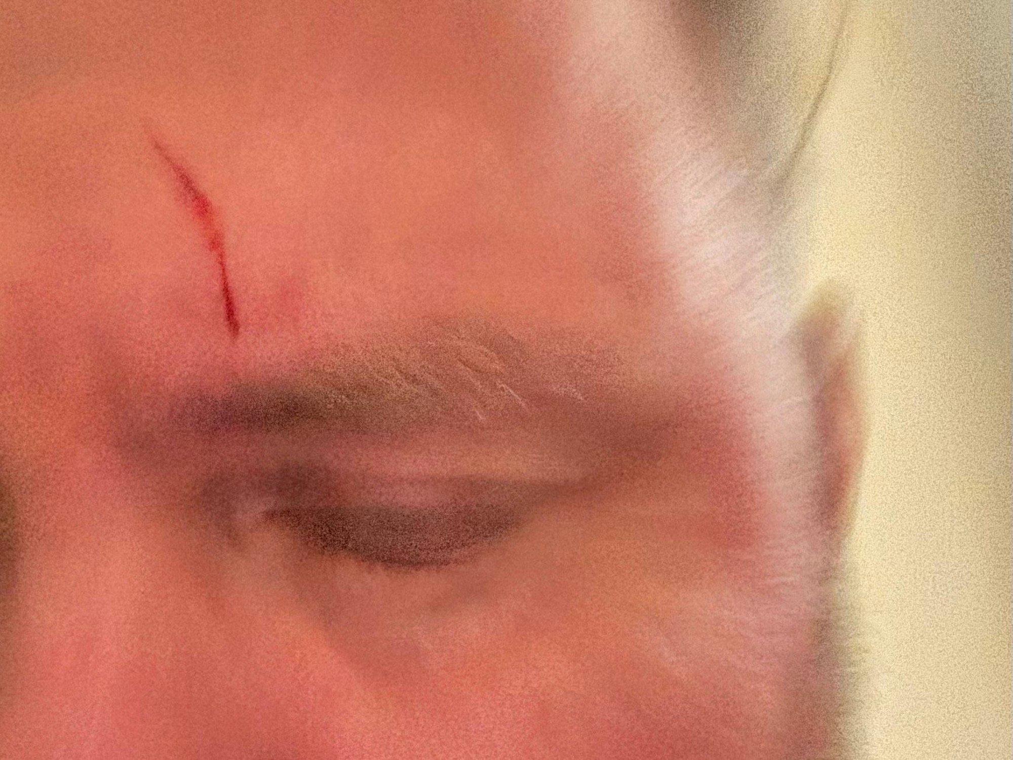 Ein Mann mit einer Platzwunde auf der Stirn.