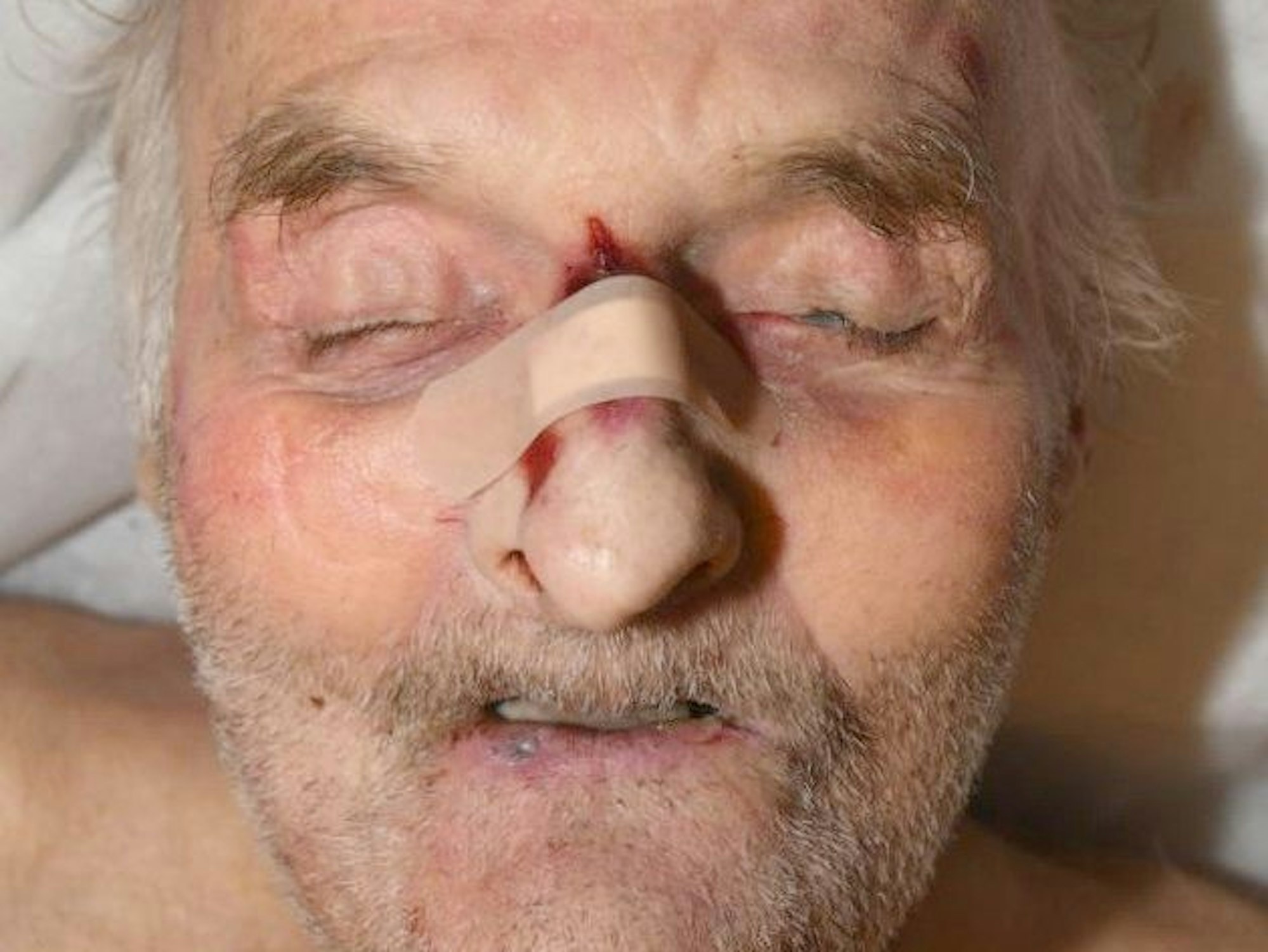 Verstorbener Mann mit einem großen Pflaster auf der Nase.