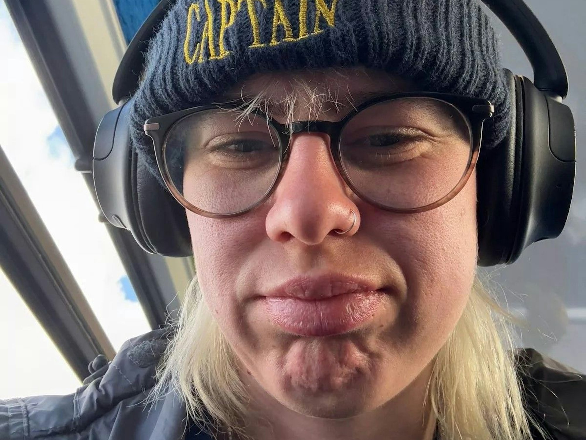 Hanna bekam ein geschwollenes Gesicht, nachdem sie ein Eis gegessen hatte.