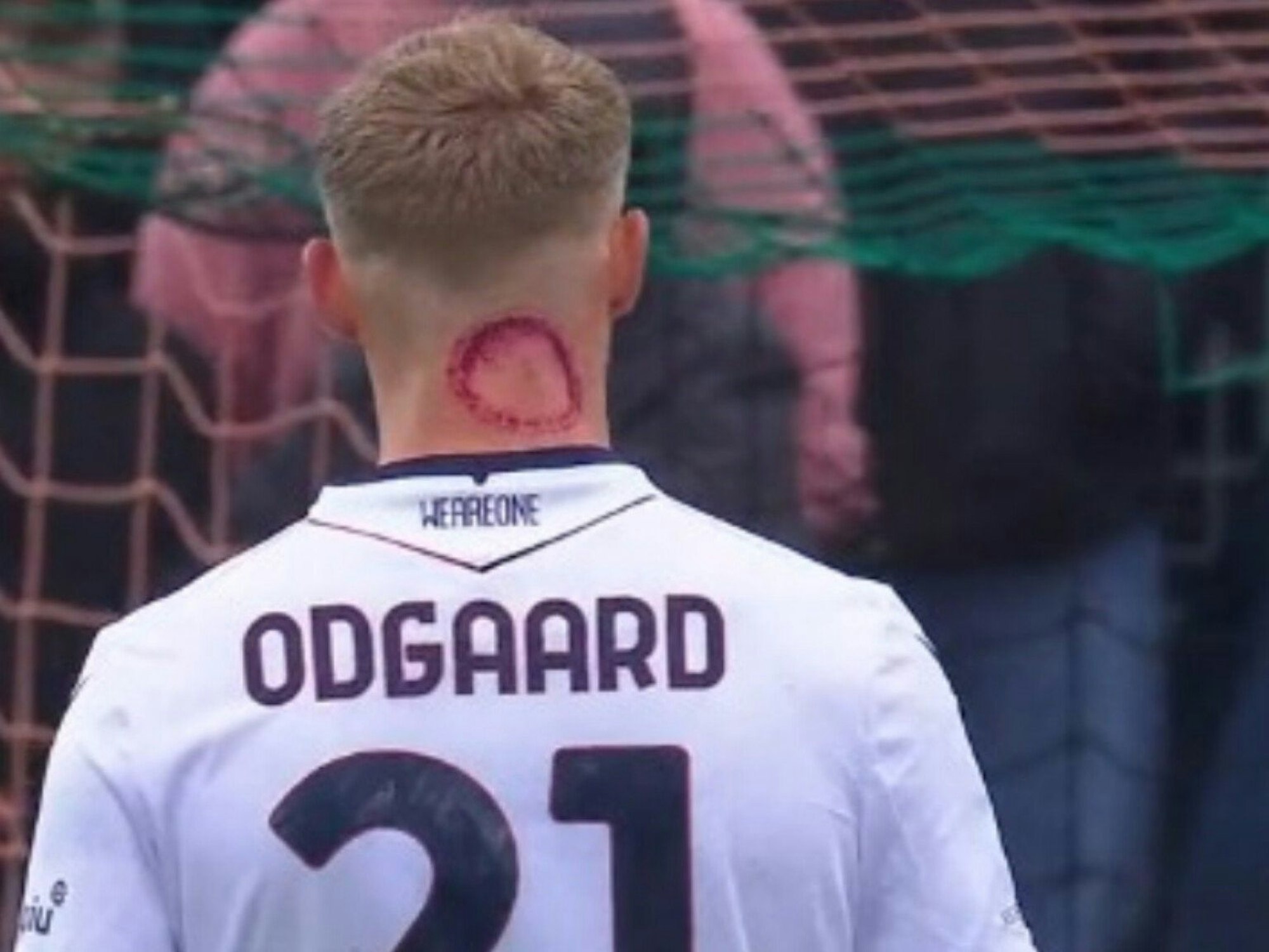 Jens Odgaard mit einem auffälligen roten Kreis im Nacken.