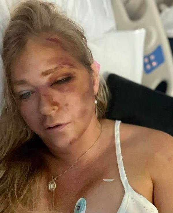 Zu sehen ist Virginia Giuffre mit blauen Flecken und Unfallblessuren in einem Krankenhausbett.