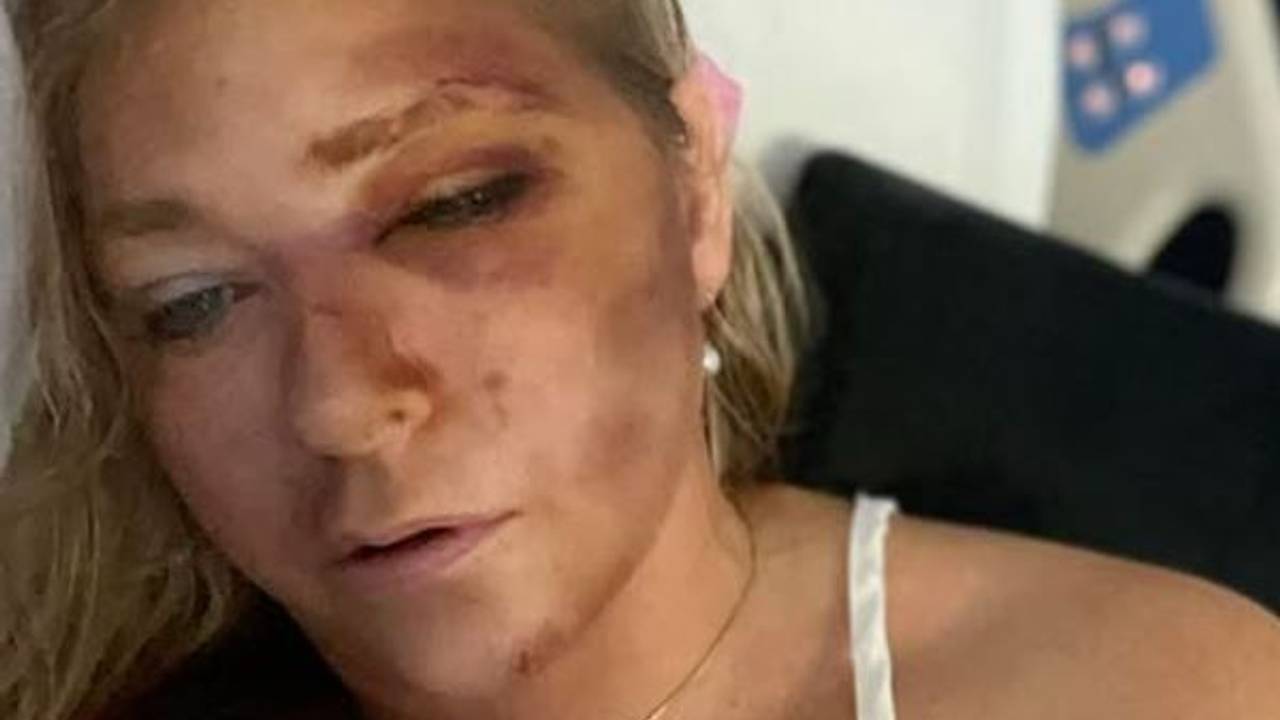 Zu sehen ist Virginia Giuffre mit blauen Flecken und Unfallblessuren in einem Krankenhausbett.