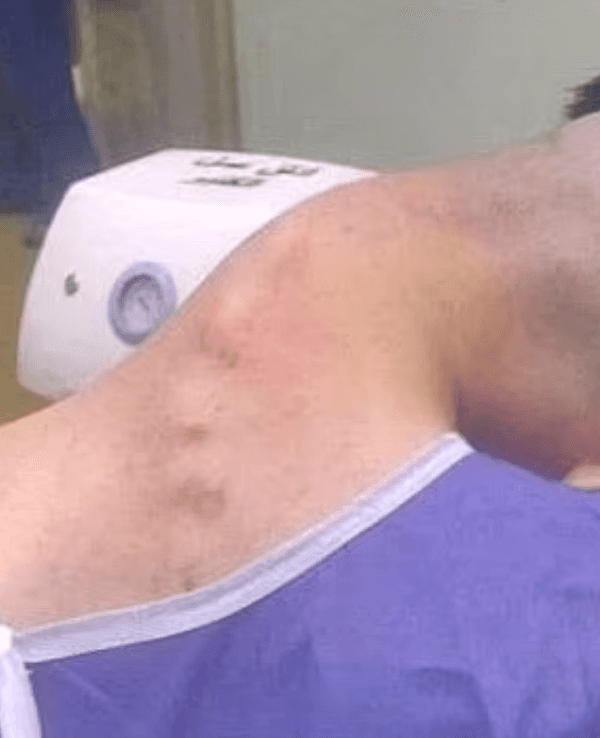 Schockierende Bilder haben eine wenig bekannte, verheerende Auswirkung des starken Drogenkonsums offenbart: einen Zustand, der als Dropped-Head-Syndrom bekannt ist.