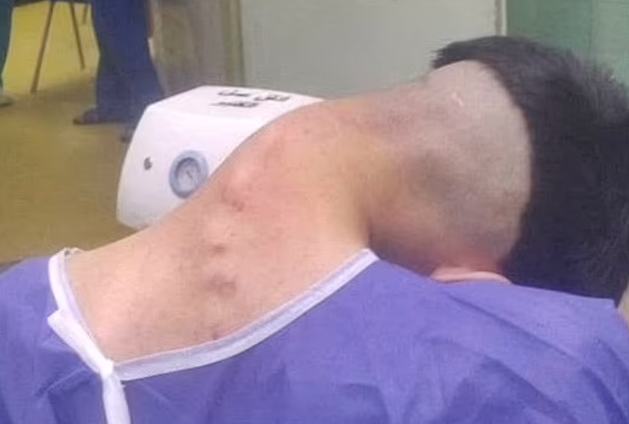 Schockierende Bilder haben eine wenig bekannte, verheerende Auswirkung des starken Drogenkonsums offenbart: einen Zustand, der als Dropped-Head-Syndrom bekannt ist.