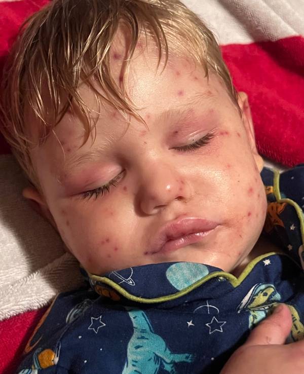 Beckham Reed (2) ist gezeichnet von den vielen Wespenstichen.